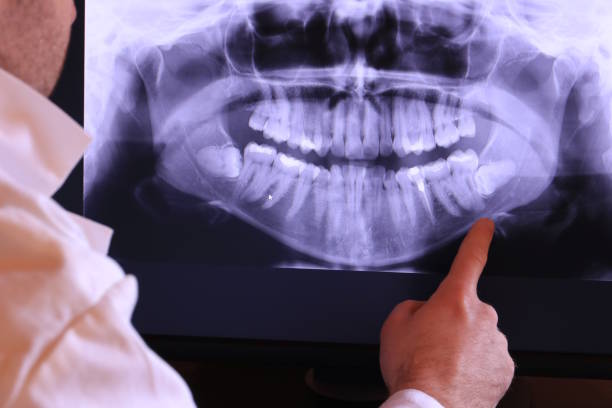 Best Emergency Wisdom Teeth Removal in Parker, TX
